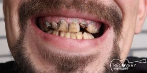 Meth Addiction and Drug Addiction Affects on Teeth