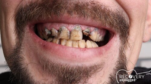 Meth Addiction and Drug Addiction Affects on Teeth|Meth Addiction and Drug Addiction Affects on Teeth|Meth Addiction and Drug Addiction Affects on Teeth||Meth Addiction and Drug Addiction Affects on Teeth|Meth Addiction and Drug Addiction Affects on Teeth