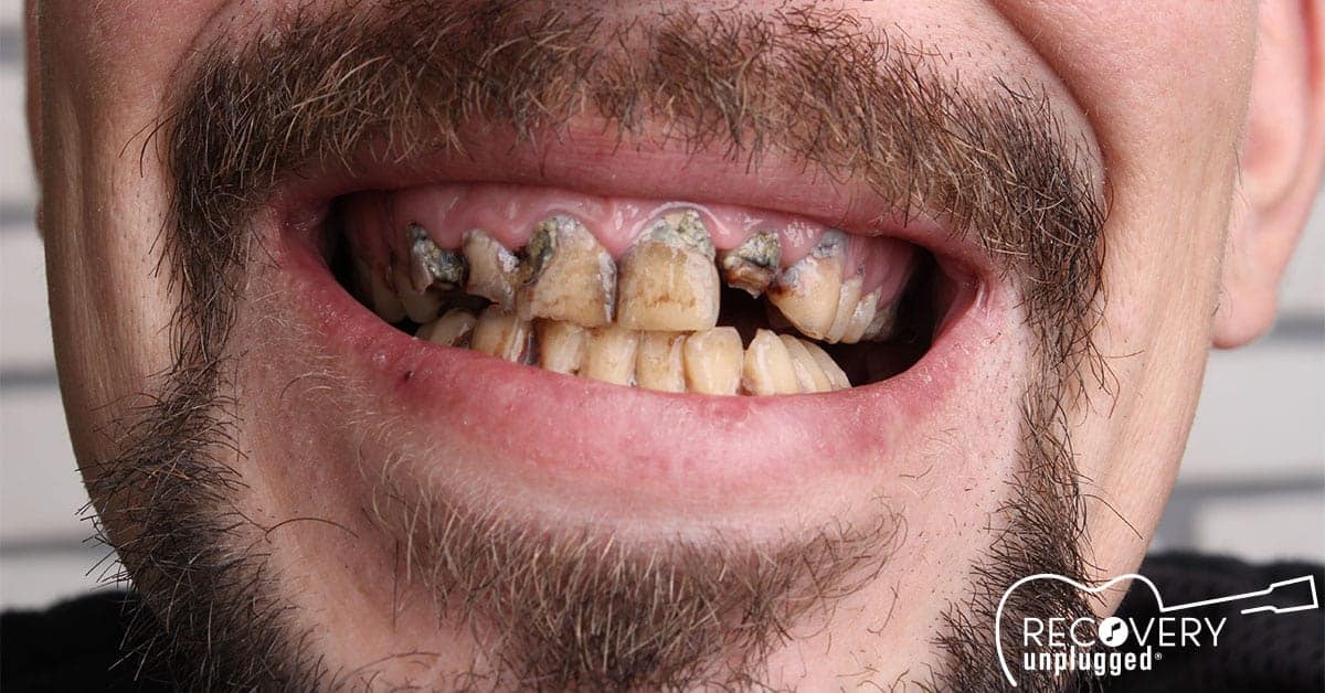 Meth Addiction and Drug Addiction Affects on Teeth|Meth Addiction and Drug Addiction Affects on Teeth|Meth Addiction and Drug Addiction Affects on Teeth||Meth Addiction and Drug Addiction Affects on Teeth|Meth Addiction and Drug Addiction Affects on Teeth